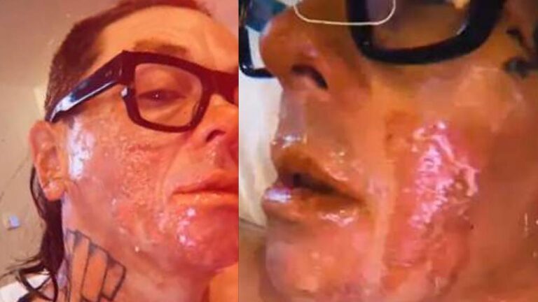 Sid Wilson, le DJ de Slipknot, montre ses horribles brûlures suite à un accident agricole ; il promet de continuer la tournée